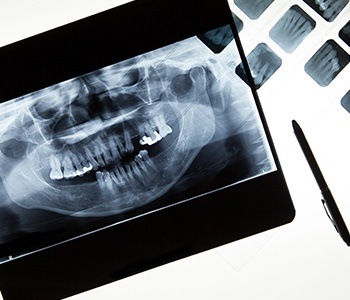 Dental x-rays on computer screen