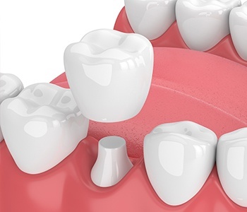 Animation of dental crown placement