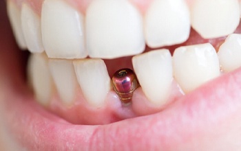 A person’s bottom and top teeth showing with a dental implant post exposed and awaiting a custom dental crown