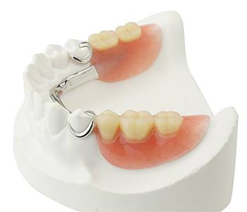 A mouth mold that contains a partial denture, complete with metal clasps to hold it in place