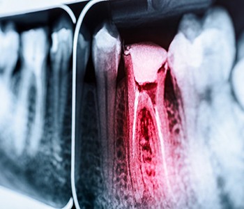 X-ray diagram of a toothache in Carrollton