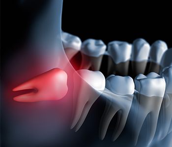 Animation of impacted wisdom tooth