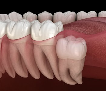 Impacted wisdom tooth