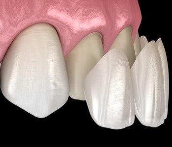 Porcelain veneers